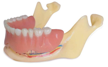 Modèle d'étude de la mâchoire inférieure avec 4 implants de forme cylindrique