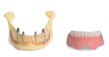 Modèle d'étude de la mâchoire inférieure avec 4 implants de forme cylindrique